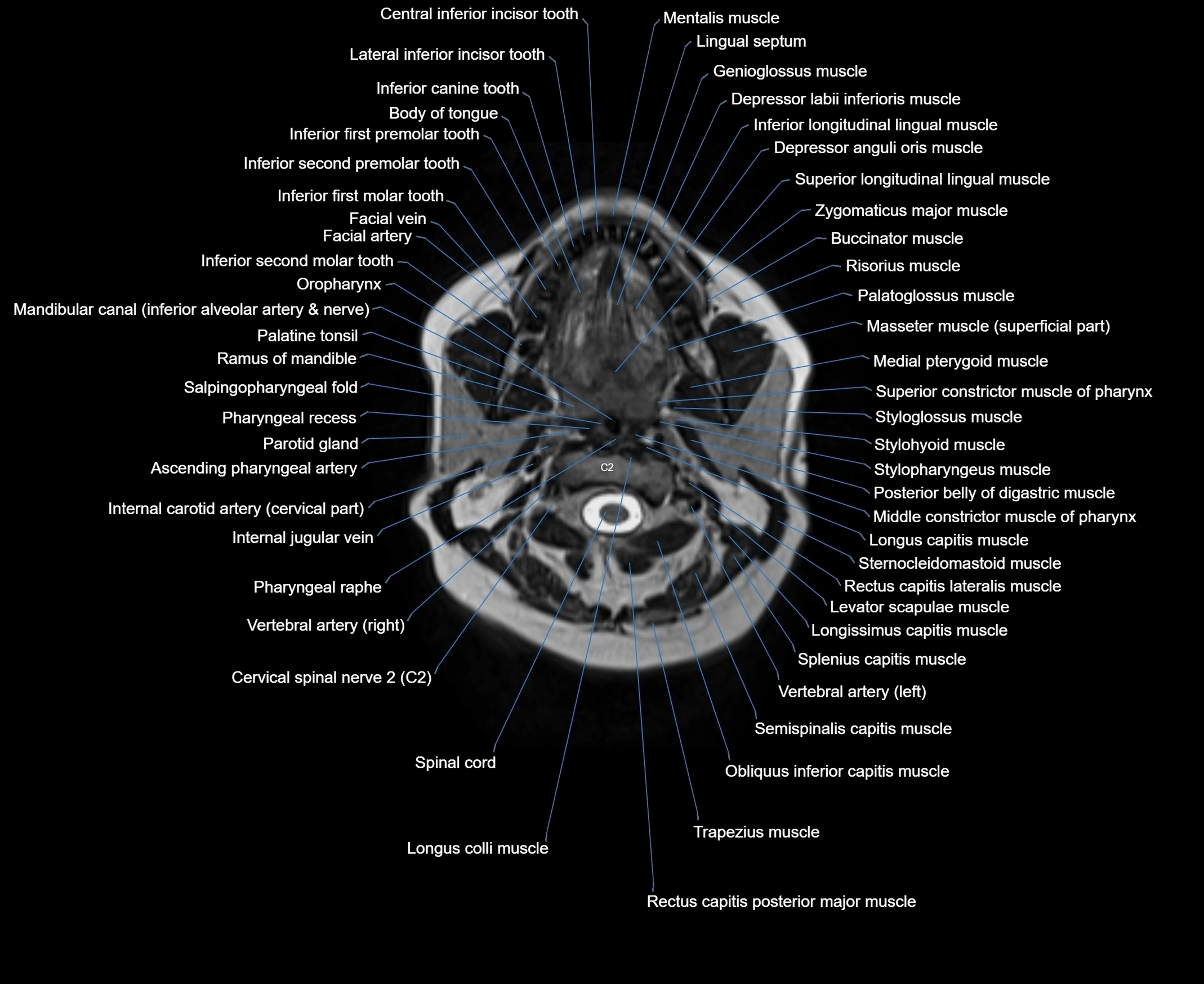 MRI Neck 3D labelled cross section anatomy axial 3t image-00001-00033.webp